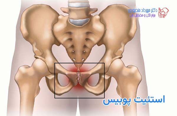 استئیت پوبیس چیست و چرا موجب درد جلوی لگن و کشاله ران میشود 1 استئیت پوبیس چیست