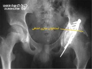 استخوانسازی اضافه بعد از جراحی شکستگی استابولوم لگن