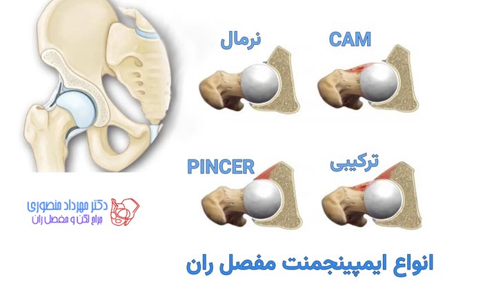 گیر افتادگی مفصل ران یا سندرم گیر کردن مفصل ران چیست 3 انواع ایمپینجمنت یا گیر کردن مفصل ران در لگن