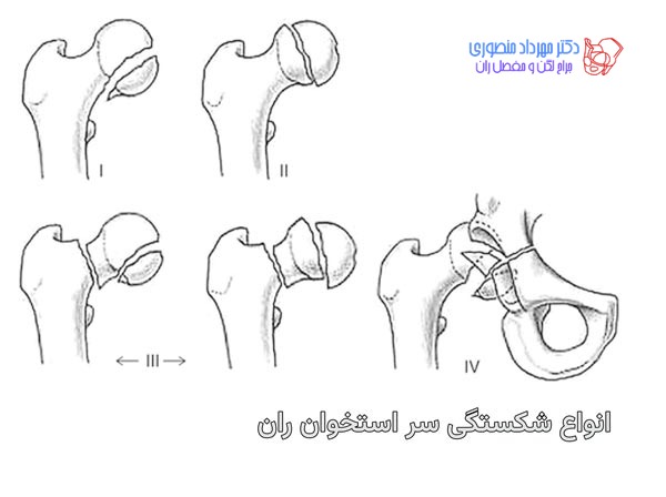 شکستگی سر استخوان ران. پیپکینز 2 شکستگی سر استخوان ران یا پیپکینز