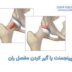 ایمپینجمنت یا گیر کردن مفصل ران چیست