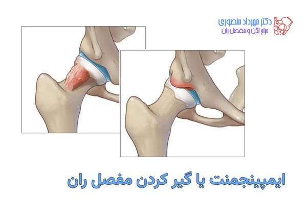گیر افتادگی مفصل ران یا سندرم گیر کردن مفصل ران چیست 1 ایمپینجمنت یا گیر کردن مفصل ران چیست