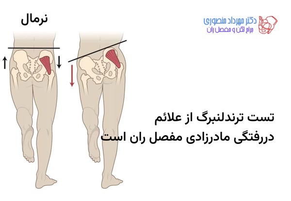 تست ترندلنبرگ در دررفتگی مادرزادی لگن و مفصل ران