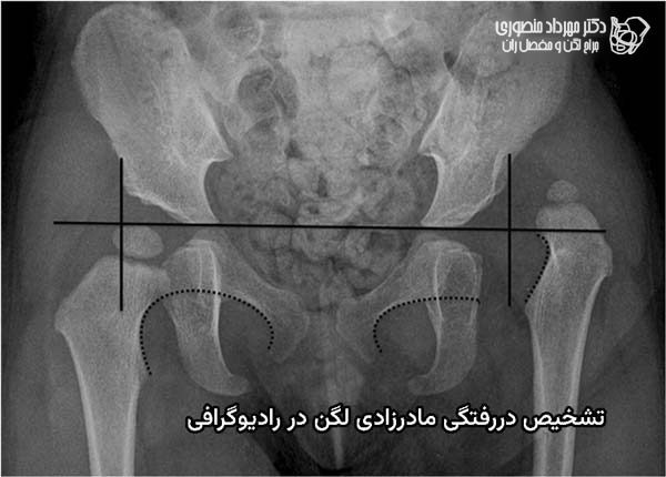 عکس دررفتگی لگن نوزاد. کمک رادیوگرافی به تشخیص دررفتگی مادرزادی لگن