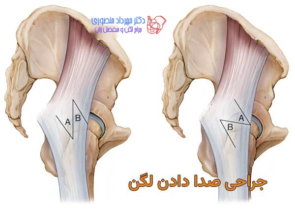 درمان صدا دادن مفصل لگن