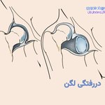 دررفتگی لگن چیست و چگونه درمان میشود