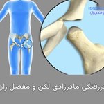 دررفتگی لگن مادرزادی