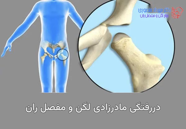 دررفتگی لگن مادرزادی