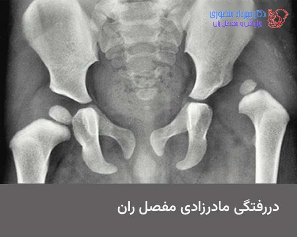 عکس دررفتگی لگن نوزاد. سر کروی شکل استخوان ران در داخل حفره استابولوم قرار ندارد