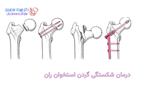 شکستگی گردن استخوان ران و درمان آن