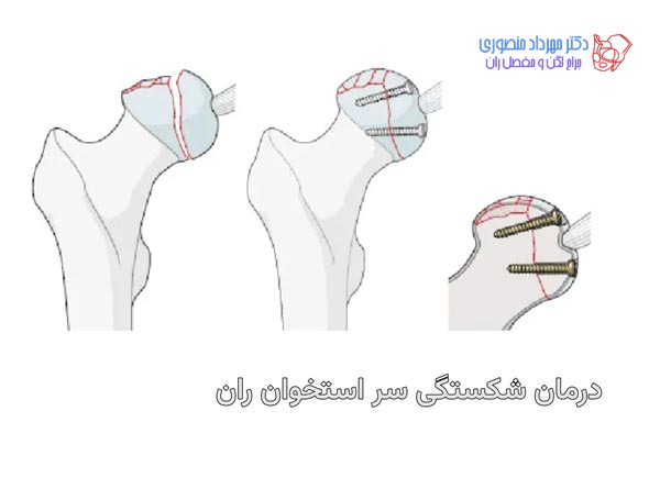 شکستگی سر استخوان ران. پیپکینز 3 شکستگی سر استخوان ران یا پیپکینز