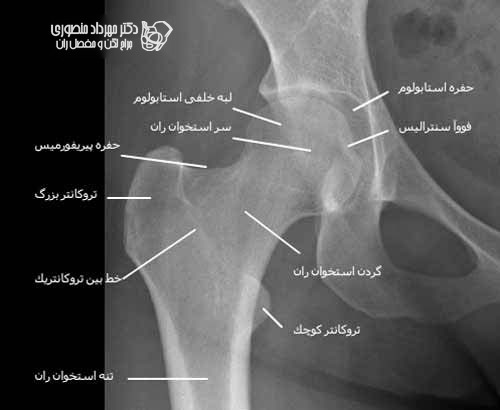 آناتومی لگن و مفصل ران، تفاوت آناتومی لگن زن و لگن مرد 60 عکس رادیوگرافی رخ مفصل ران سالم با سر استخوان ران و حفره استابولوم