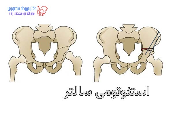 عمل جراحی دررفتگی لگن مادرزادی. استئوتومی استخوان لگن برای تغییر زوایای استابولوم و کمک به جااندازی مفصل ران