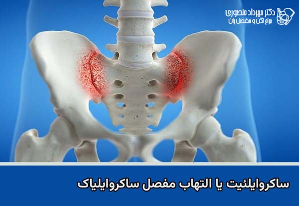 التهاب مفصل ساکروایلیاک از علل مهم درد پشت باسن است