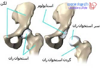 آناتومی لگن و مفصل ران، تفاوت آناتومی لگن زن و لگن مرد 8 عکس آناتومی لگن. سر استخوان ران و حفره استابولوم در مفصل ران