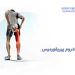 سندروم پیریفورمیس چیست