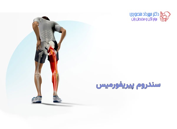 سندروم پیریفورمیس چیست
