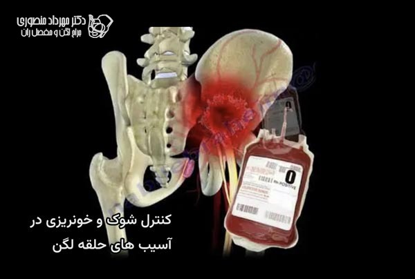 شوک و خونریزی ناشی از آسیب و شکستگی حلقه لگن