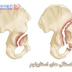 شکستگی استابولوم