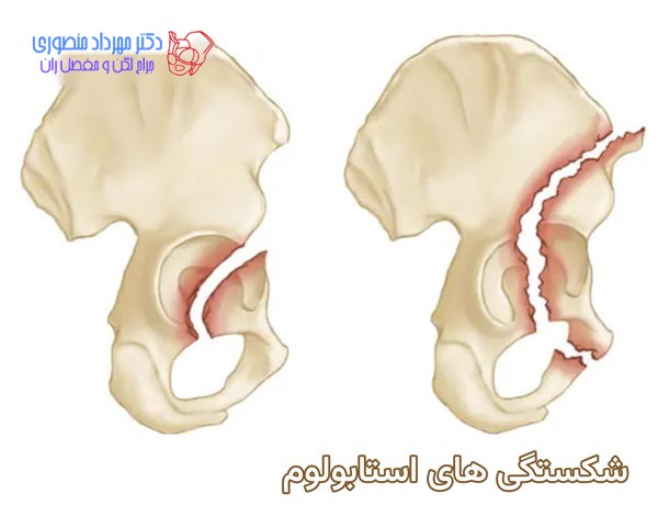 شکستگی لگن در ناحیه استابولوم در لگن چه خصوصیاتی دارد
