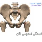 شکستگی استرسی لگن چیست