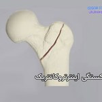 شکستگی اینترتروکانتریک چیست و چگونه درمان میشود
