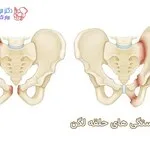 شکستگی در ناحیه حلقه لگنی چه خصوصیاتی دارد