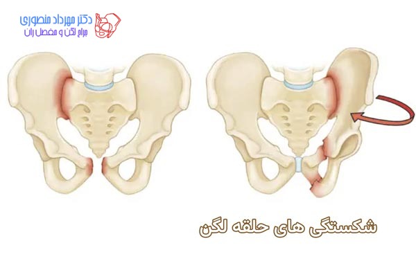 شکستگی لگن در ناحیه حلقه لگنی چه خصوصیاتی دارد