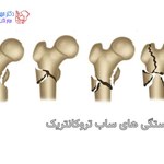 شکستگی ساب تروکانتریک چیست و چگونه درمان میشود
