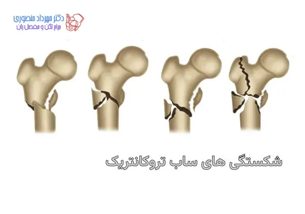 شکستگی ساب تروکانتریک استخوان ران (زیر تروکانتر کوچک): علائم، علل و درمان 1 شکستگی ساب تروکانتریک چیست و چگونه درمان میشود