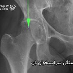 شکستگی سر استخوان ران یا پیپکینز چیست
