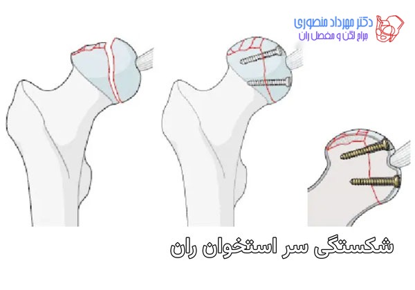 شکستگی لگن در سر استخوان ران چه خصوصیاتی دارند