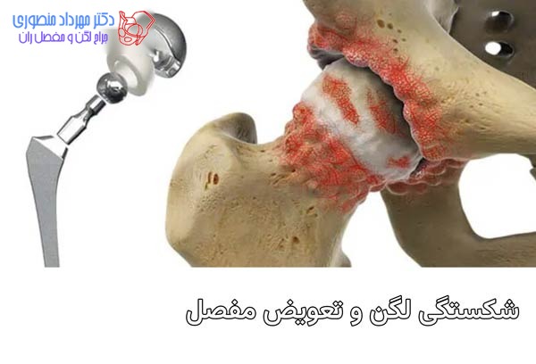 شکستگی لگن و نیاز به تعویض مفصل