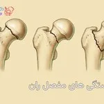 شکستگی مفصل ران چیست