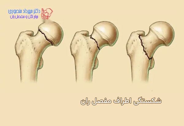 شکستگی لگن در مفصل ران چه خصوصیاتی دارند