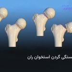 شکستگی گردن استخوان ران