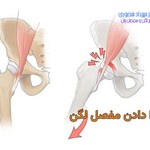 علت صدا دادن مفصل لگن و درمان آن چیست