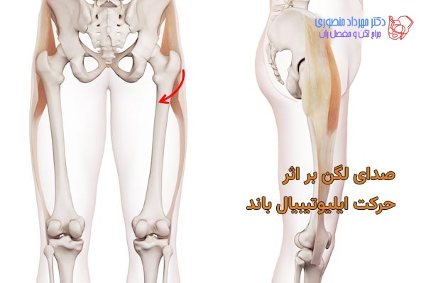 یک علت صدا دادن مفصل لگن گیر کردن ایلیوتیبیال باند است