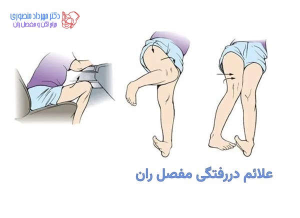 دررفتگی لگن بر اثر ضربه و تصادف: علائم، درمان و عوارض 6 علائم دررفتگی لگن چیست
