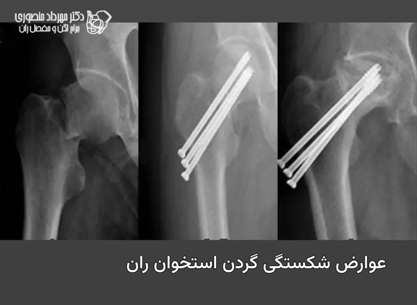 عوارض شکستگی گردن استخوان ران چیست