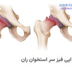 لغزش اپی فیز سر استخوان ران یا بیماری اسلیپ چیست