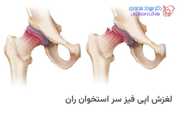 لغزش اپی فیز سر استخوان ران یا بیماری اسلیپ چیست
