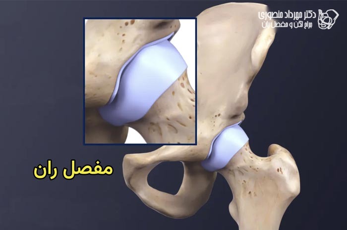 تعویض مفصل لگن (توتال هیپ) چیست؟ راهنمای کامل جراحی تعویض مفصل ران 2 آناتومی مفصل ران