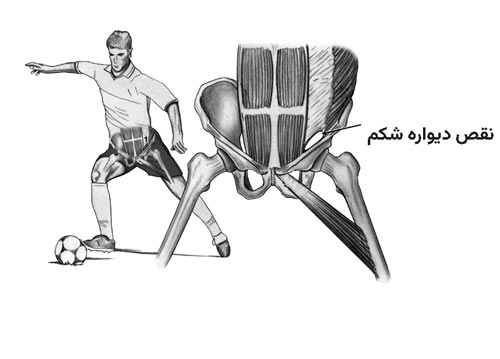 هرنی ورزشی چیست و چرا موجب درد کشاله ران میشود 3 نقص در عضلات جدار قدامی دیواره شکمی میتواند موجب هرنی ورزشی شود
