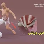 هرنی یا فتق ورزشی چیست
