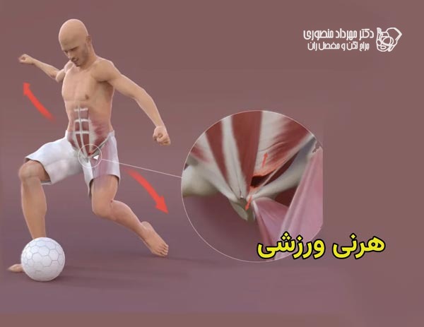 هرنی ورزشی چیست و چرا موجب درد کشاله ران میشود 1 هرنی یا فتق ورزشی چیست