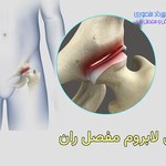 درمان پارگی لابروم مفصل ران چیست