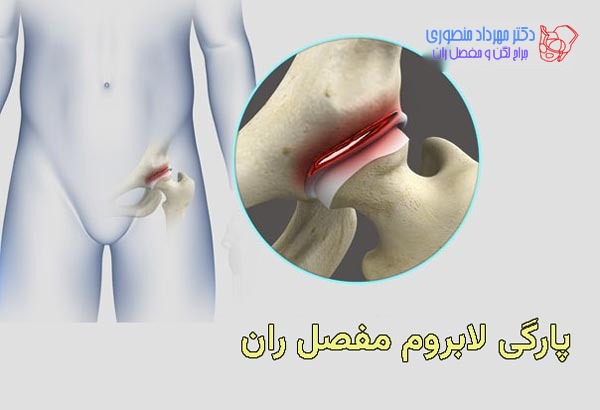 درمان پارگی لابروم مفصل ران چیست