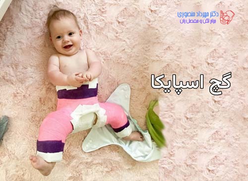 استفاده از گچ گیری اسپایکا برای نگه داشتن مفصل ران بعد از جاانداختن دررفتگی لگن
