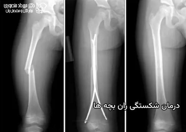 درمان شکستگی ران در بچه ها چگونه است